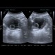 Cystitis, acute cystitis: US - Ultrasound